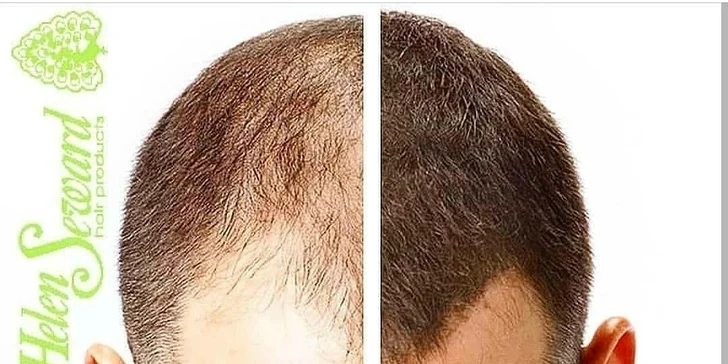 Účinné vlasové terapie s trichogramom v salóne R.studio healthy hair