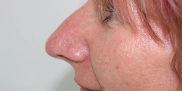 Jednoduchá či kompletná rhinoplastika nosa vykonávaná plastickým chirurgom v Scarlett Clinic