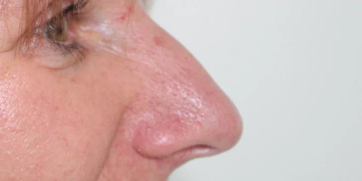 Jednoduchá či kompletná rhinoplastika nosa vykonávaná plastickým chirurgom v Scarlett Clinic