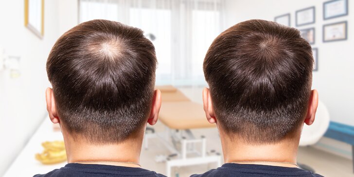 Liečba straty vlasov pre mužov i ženy pomocou invazívnej mezoterapie