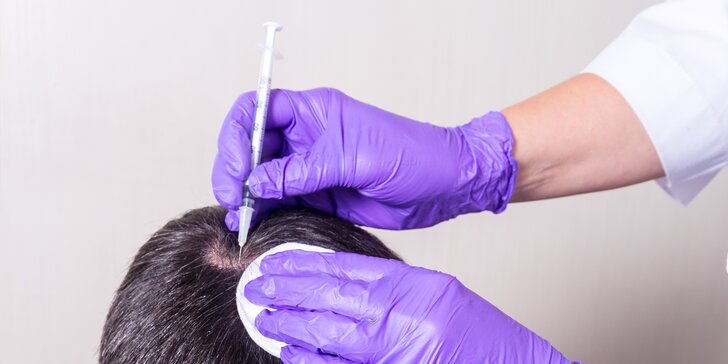Drakuloterapia - zastavenie vypadávania vlasov u mužov