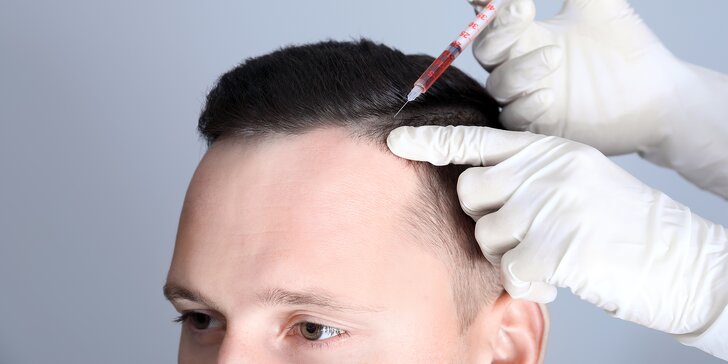 Drakuloterapia - zastavenie vypadávania vlasov u mužov
