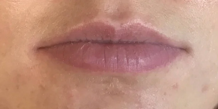 Pre krásnu a vypnutú pleť: aplikácia kyseliny hyalurónovej