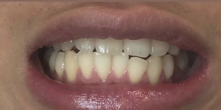 Bielenie zubov bez peroxidu vodíka o 2-12 odtieňov!