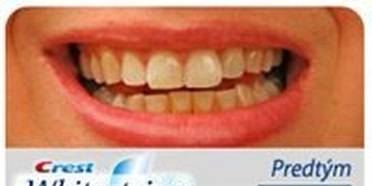 39,99 eur za bieliace pásiky Crest na zuby na domáce použitie! Viac ako 30 miliónov spokojných zákazníkov po celom svete! Očarte žiarivo bielym úsmevom so zľavou 51%!