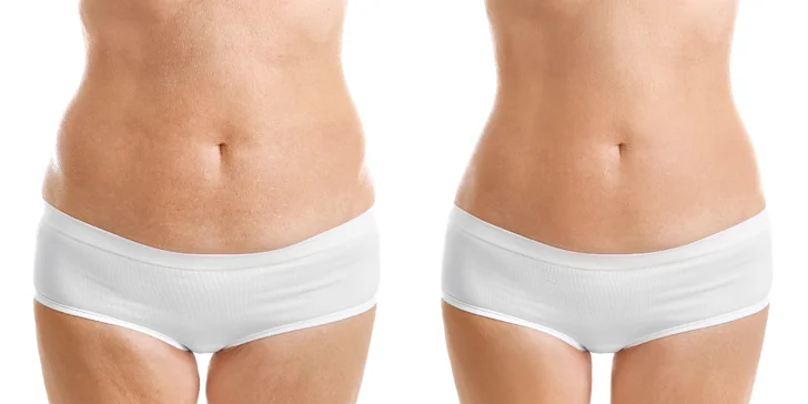 Neinvázivna prístrojová liposukcia v Health & beauty clinic