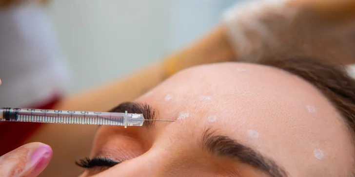 Aplikácia botoxu proti vráskam alebo poteniu v salóne Diva Beauty