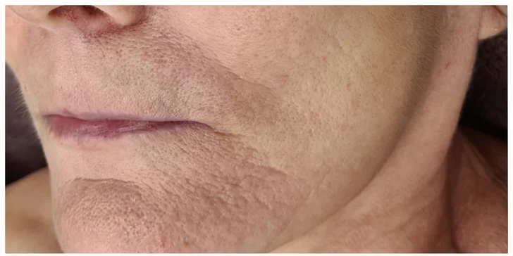 Mezoterapia tváre či vlasov alebo microneedling