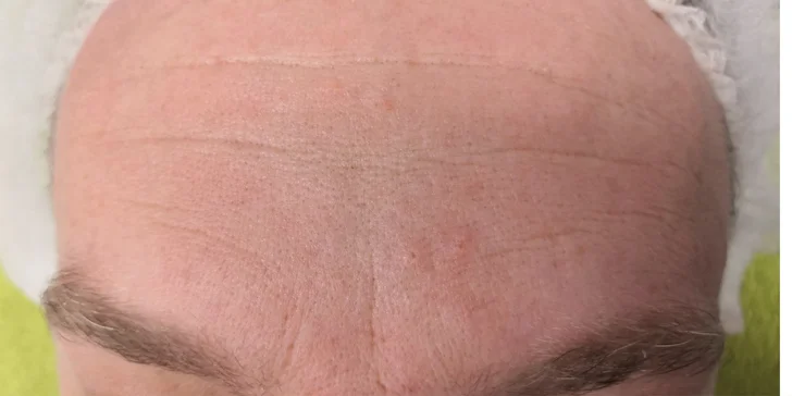Mezoterapia tváre či vlasov alebo microneedling
