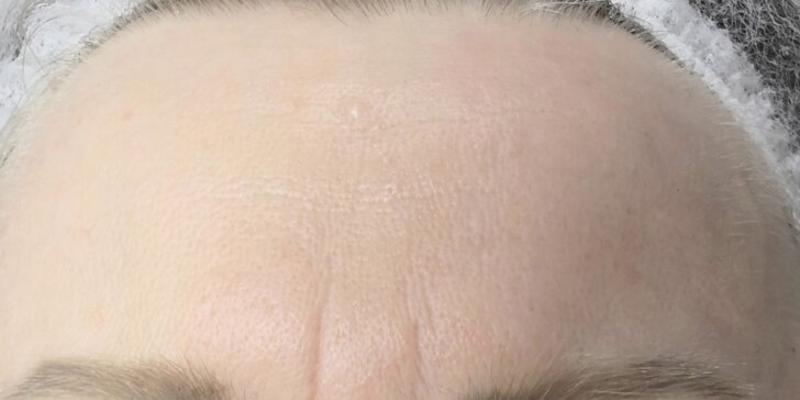 Viditeľné a bezbolestné omladenie pokožky tváre i problémových partií s microneedlingom