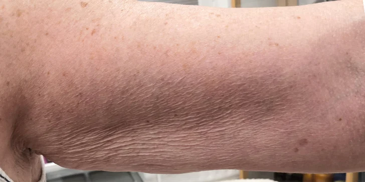 Mezoterapia tváre či vlasov alebo microneedling