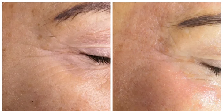 Mezoterapia tváre či vlasov alebo microneedling