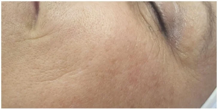 Ošetrenie pleti: Zapracovanie dermatologických kapsúl magnetickou infúziou