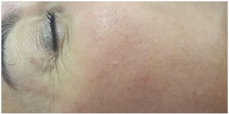 Ošetrenie pleti: Zapracovanie dermatologických kapsúl magnetickou infúziou