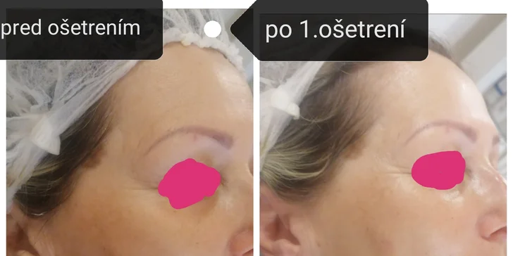Zoštíhľujúce procedúry a vypnutie pleti prístrojom Zoner ANTIAGE Trilogy