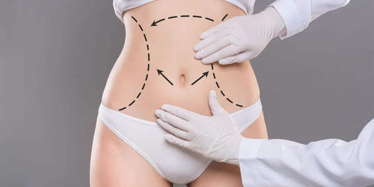 Zbavte sa nežiadúceho tuku natrvalo - laserová liposukcia