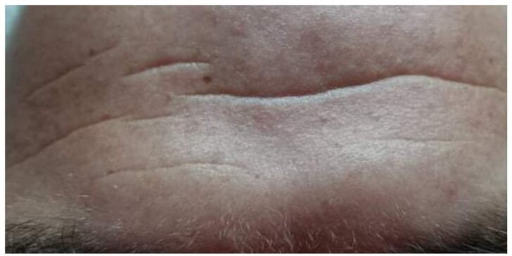 Odstránenie kožných nedostatkov pomocou lasera Sparidonn, Gua sha masáž alebo kúra proti rozšíreným cievkam