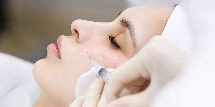 Biorevitalizácia pleti technológiou PRX - T33, v ponuke aj permanentka