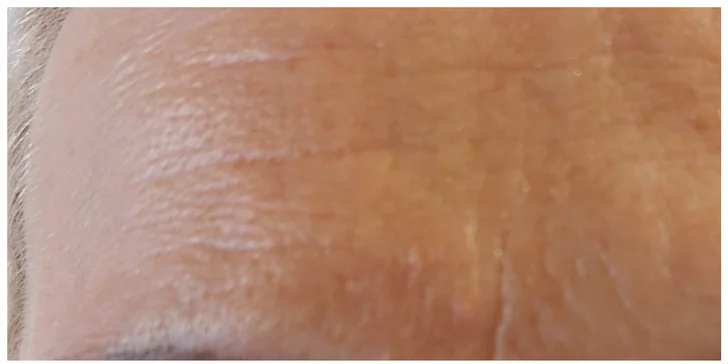 Plasma Pen: zbavte sa vrások pomocou plazmového pera