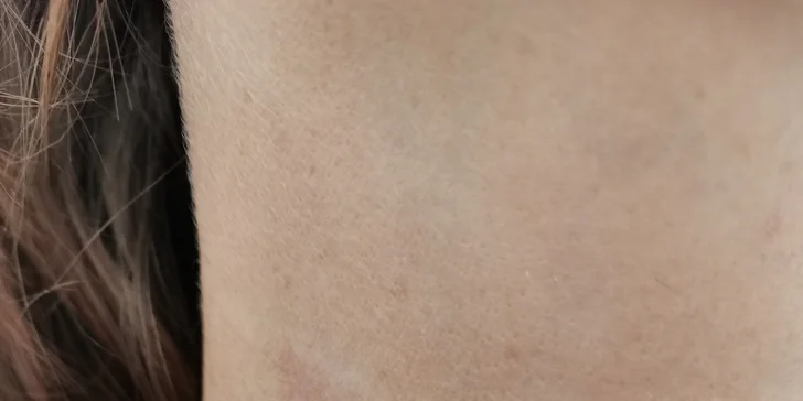 Biostimulačné ošetrenie pokožky kozmetickým laserom Sparidonn