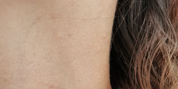Odstránenie kožných nedostatkov pomocou lasera Sparidonn, Gua sha masáž alebo kúra proti rozšíreným cievkam