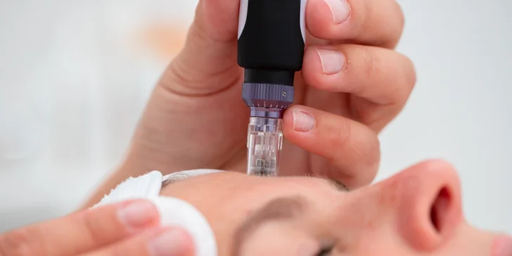 Mezoterapia-Microneedling alebo chemický peeling, v ponuke aj permanentky
