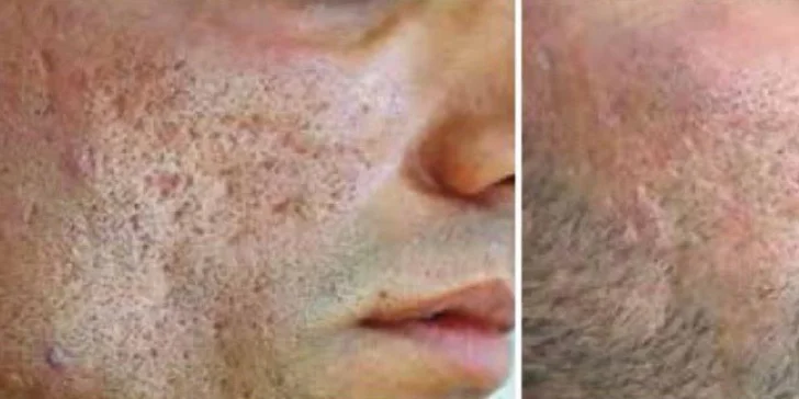 Omladenie frakčným CO2 laserom v Health & beauty clinic Košice