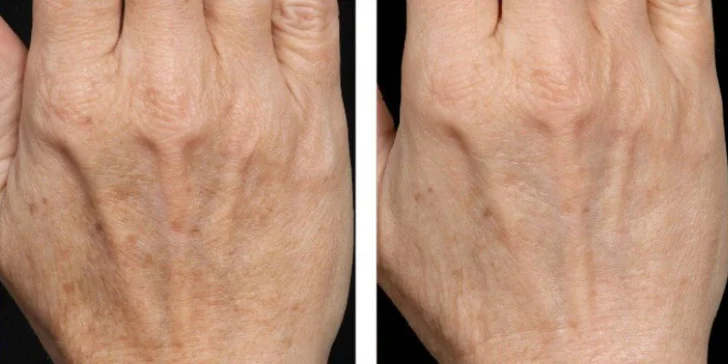 Omladenie frakčným CO2 laserom v Health & beauty clinic Košice