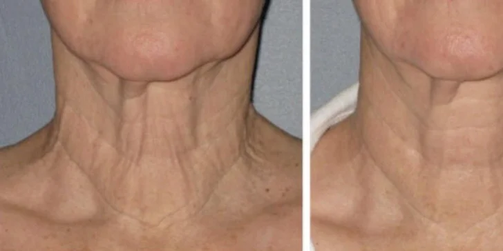 Omladenie frakčným CO2 laserom v Health & beauty clinic Košice