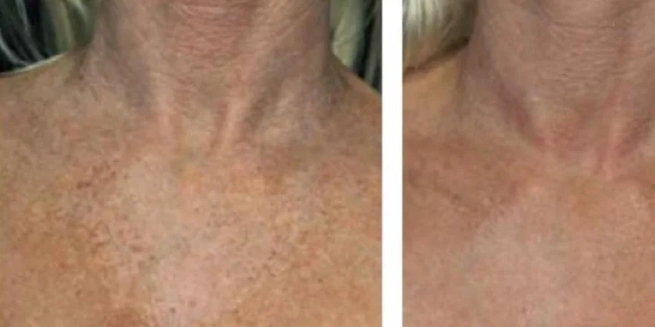 Omladenie frakčným CO2 laserom v Health & beauty clinic Košice