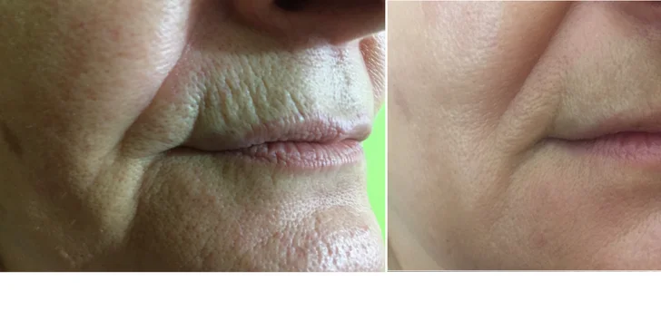 Omladenie frakčným CO2 laserom v Health & beauty clinic Košice