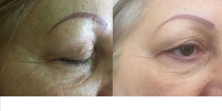 Omladenie frakčným CO2 laserom v Health & beauty clinic Košice