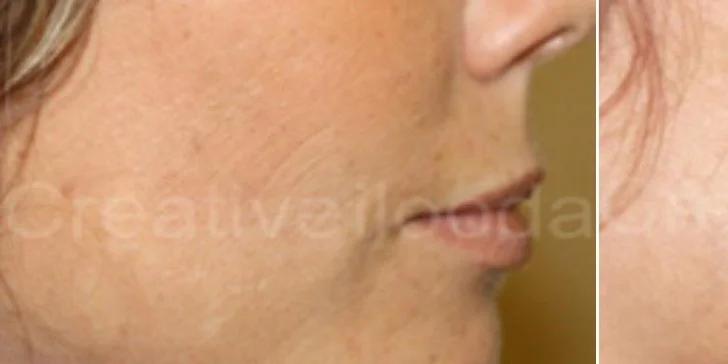 Omladenie frakčným CO2 laserom v Health & beauty clinic Košice