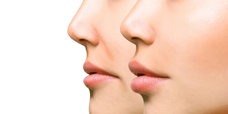 Zväčšenie pier výplňou Princess® Filler alebo Princess® Volume