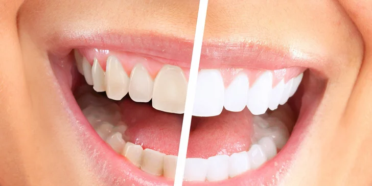 LED Bielenie zubov bieliacim gélom PEARLSMILE®
