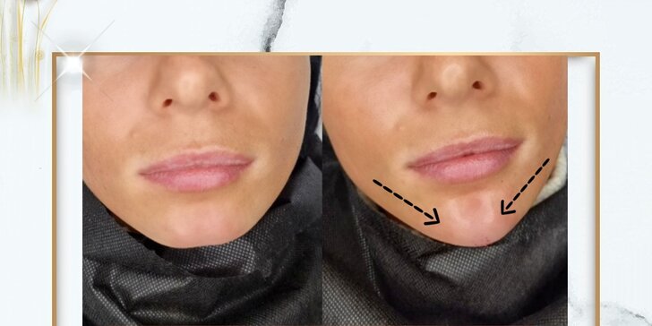 Výplň pier kyselinou hyalurónovou metódou Stripp Lips aj s korekciou vybranej oblasti tváre