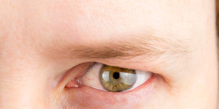 Plastická operácia horných a dolných očných viečok v Dermahouse