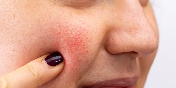Odstránenie kožných nedostatkov pomocou lasera Sparidonn, Gua sha masáž alebo kúra proti rozšíreným cievkam