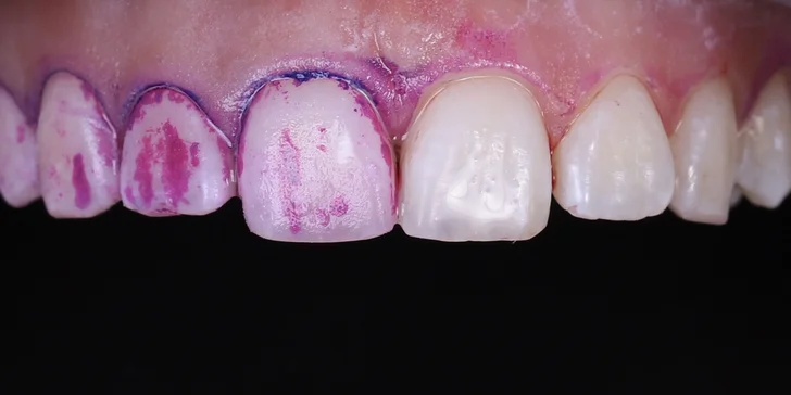 Dentálna hygiena s pieskovaním pre dospelých aj deti do 15 rokov