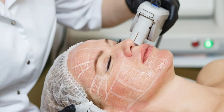 Horný, dolný a celkový facelifting ULTHERA