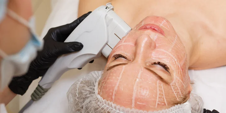 Horný, dolný a celkový facelifting ULTHERA