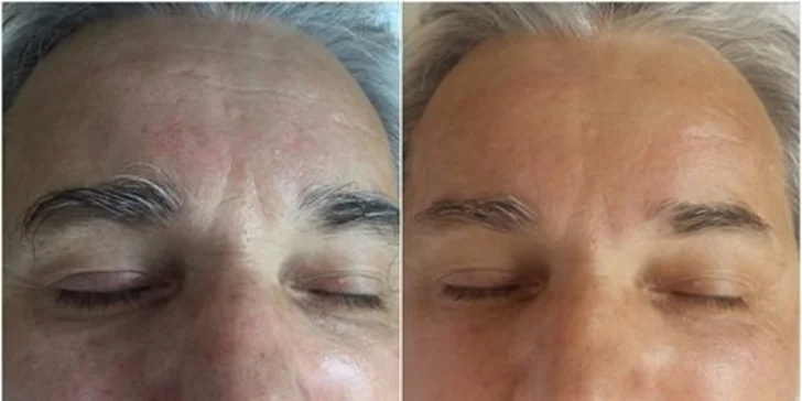 Inovatívne pleťové ošetrenia proti akné či starnutiu alebo 3D lifting