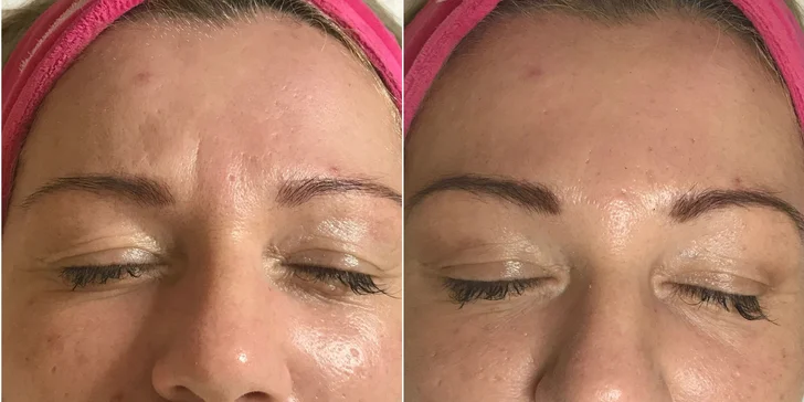 Aplikácia kyseliny hyalúronovej Vital Injectorom