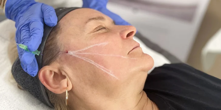 Špeciálny lifting tváre vykonávaný pomocou vstrebateľných nití
