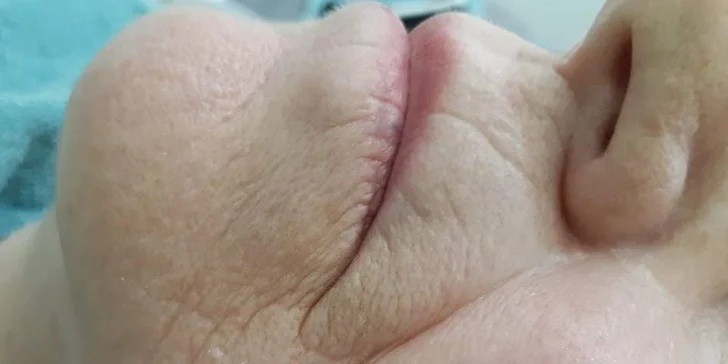 Zbavte sa vrások a spevnite pleť: Plazma lifting v salóne Ariini