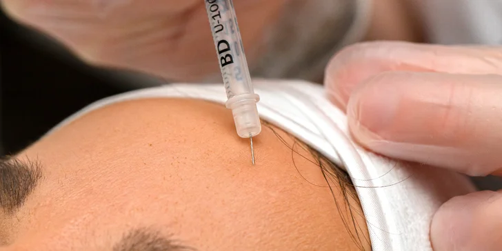 Aplikácia botulotoxínu do čela, medziobočia alebo okolia očí