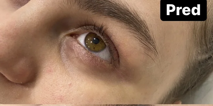 Odstránenie kruhov pod očami či korekcia horných a dolných očných viečok plazmovým lúčom vo Fabulous beauty