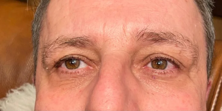 Odstránenie kruhov pod očami či korekcia horných a dolných očných viečok plazmovým lúčom vo Fabulous beauty