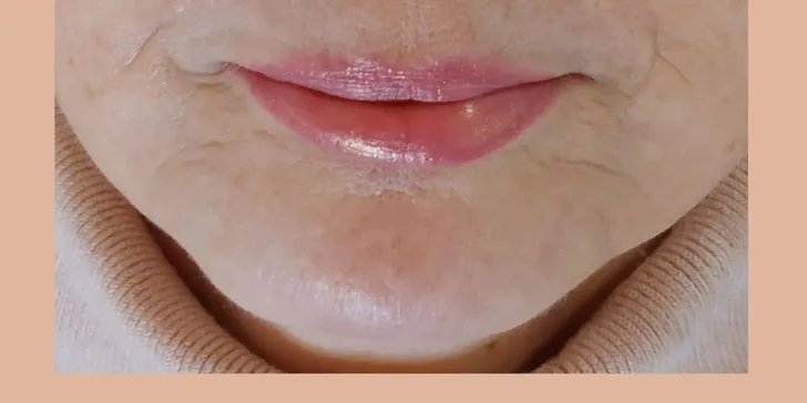 Oxygeneo terapia s rádiofrekvenciou pre spevnenú a omladenú pleť s okamžitým efektom