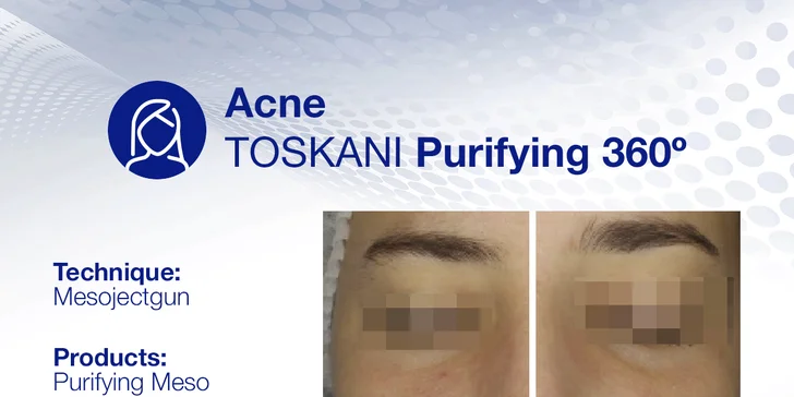 Omladnite a revitalizujte svoje vlasy s účinnou mezoterapiou v Toskani Beauty Center